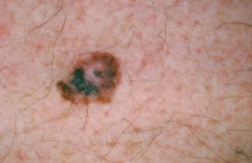 Skin cancer mole
