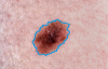 Skin Cancer Detection Image