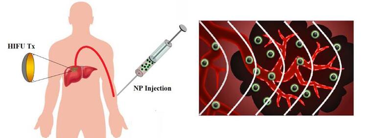 NP injection diagram