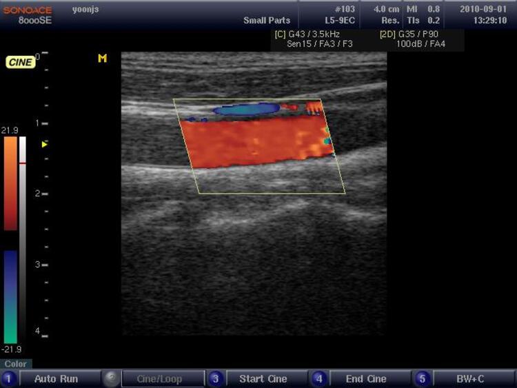 Ultrasonic measurement of radial artery