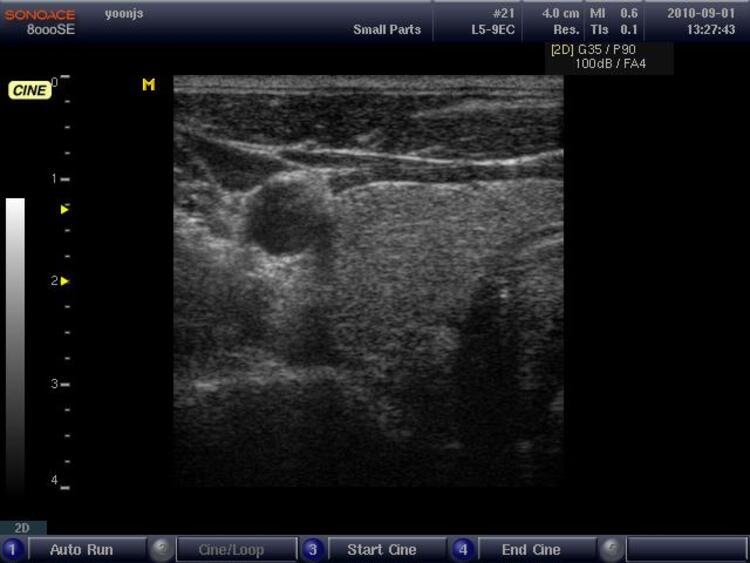 The ultrasound image of carotid artery