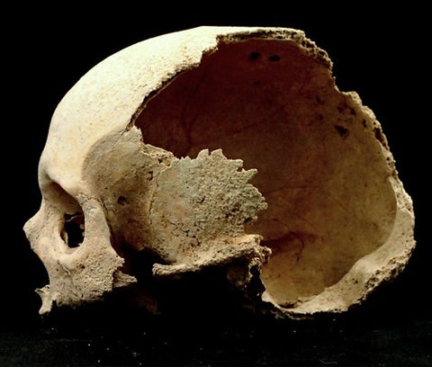 A human skull with a large section of the back missing and no jaw bone