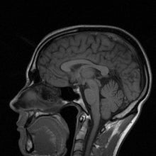 MRI photo of a human head
