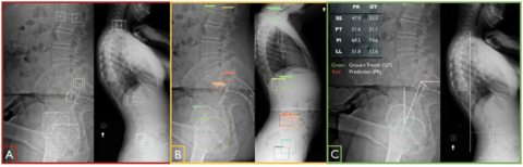 spinopelvic x-ray