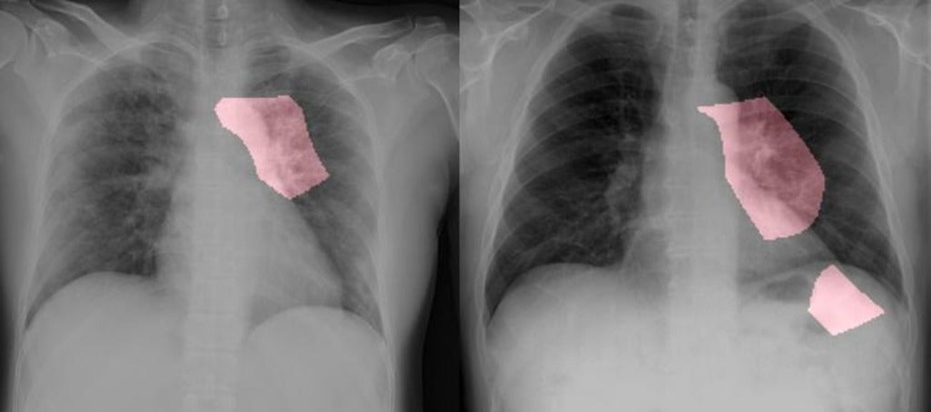 chest x-ray showing two patients with COVID-19
