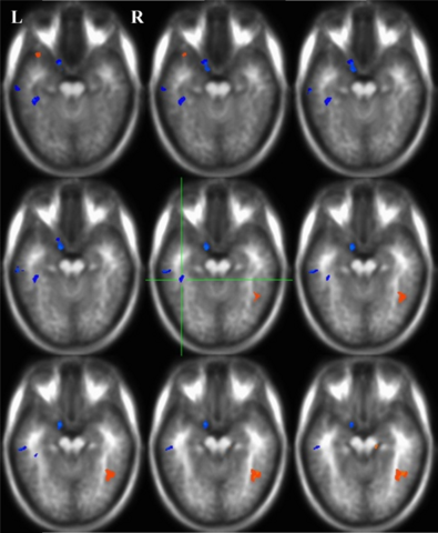 Brain scans