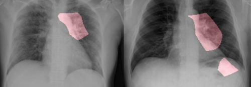 Key areas are highlighted in pink in these chest radiology images of two patients with COVID-19