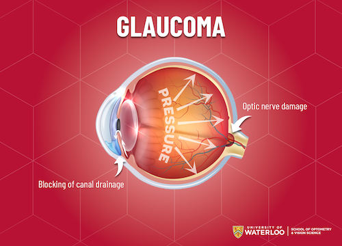 A glaucoma image showing a cut-away view of a human eye.