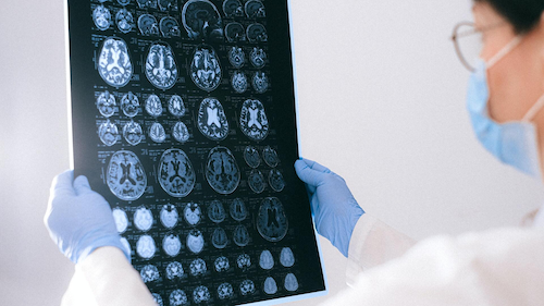 A doctor holds up an x-ray of brain scans