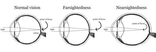 A cutaway image of three eyeballs showing normal vision, farsightedness and nearsightedness.