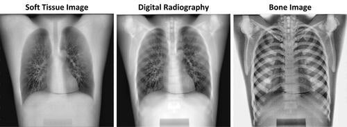 Three X-Ray images of a human chest from KA Imaging.