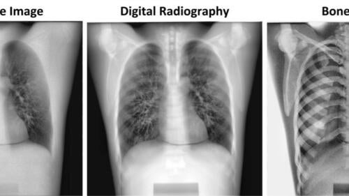 A series of chest X-Rays.