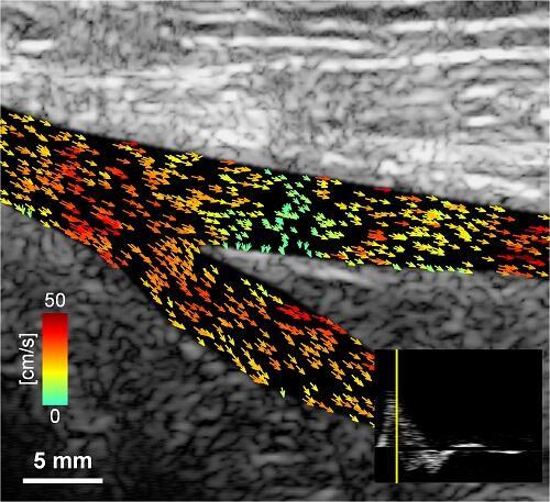 A next-generation ultrasound image created in Alfred Yu's lab shows blood travelling through a femoral artery at different speeds.