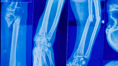 X-Rays of leg bones