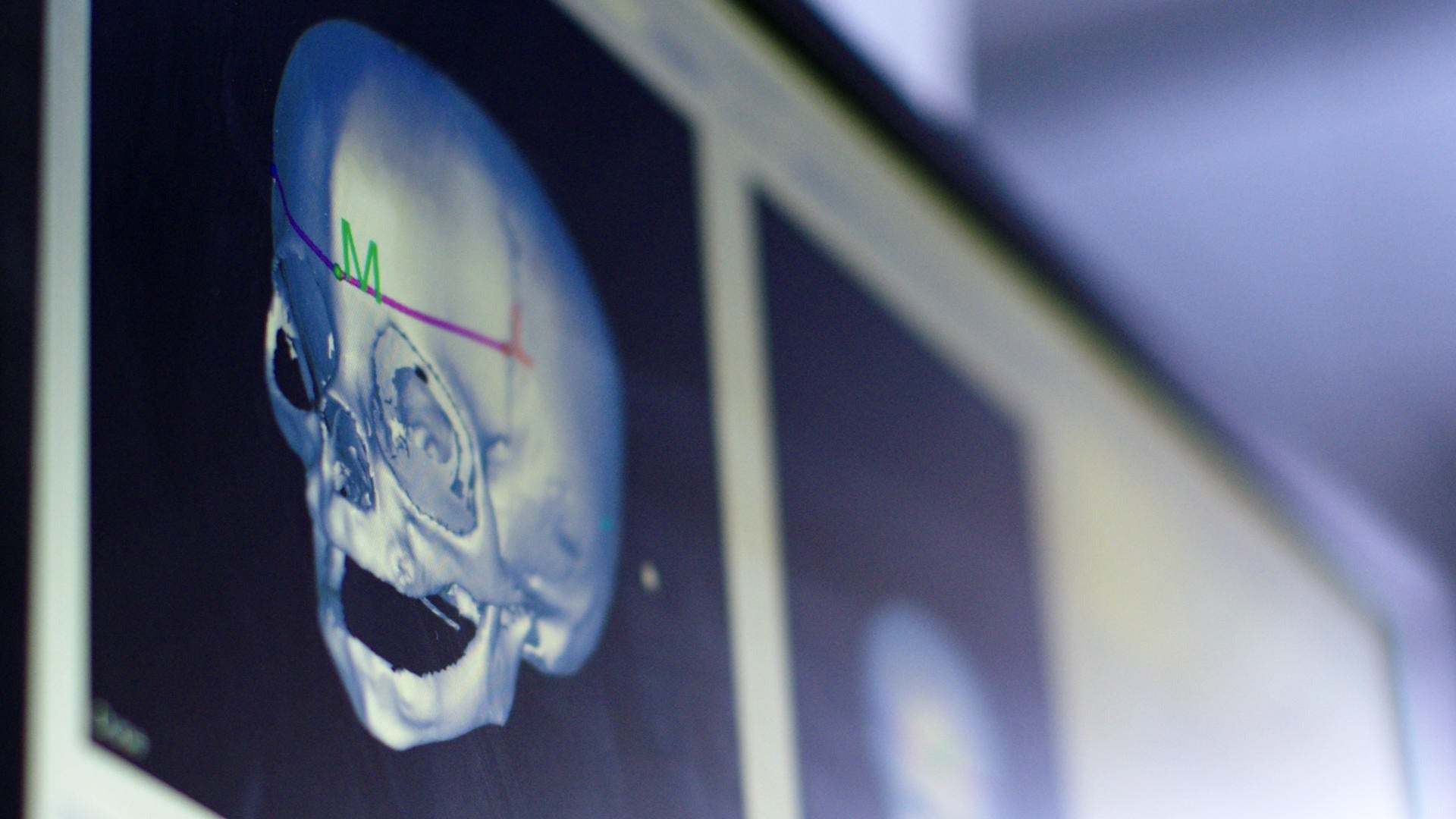 A medical image of a human skull.