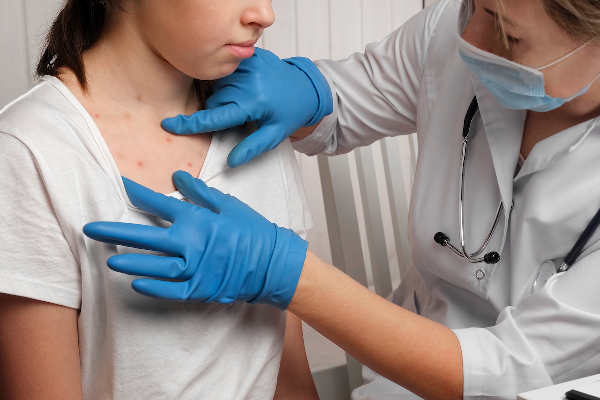 A doctor wearing blue gloves examines a patient with measles spots.