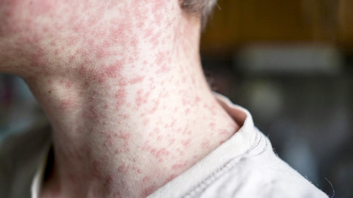 A man's head and neck covered in measles spots.