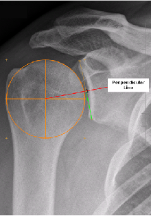 x-ray image of humeral head