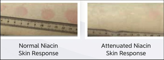 photos of niacin skin responses