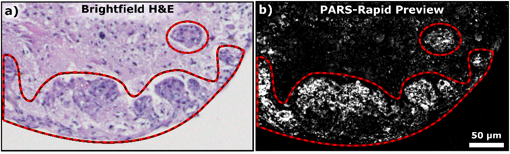 Two images, one produced in the lab (left) and the other using new PARS laser technology (right), show areas of cancer in brain tissue with comparable accuracy.