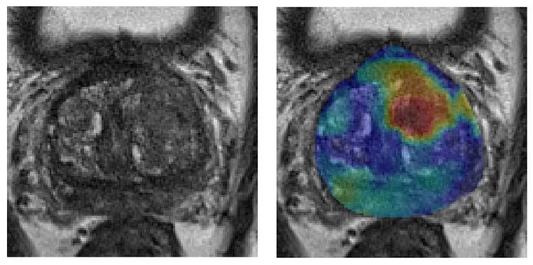 The image on the left is a standard MRI of a prostate gland. The same prostrate is shown on the right, with a cancerous tumour highlighted in red, using new MRI technology called synthetic correlated diffusion imaging.