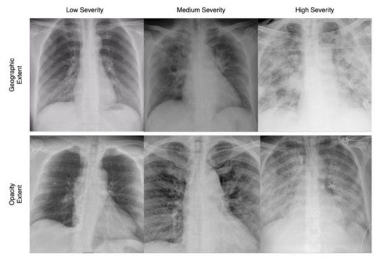 Chest x-rays of COVID-19 patients.