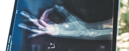 An x-ray of a hand.