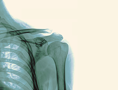 x-ray image of a shoulder