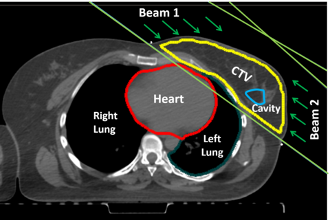 A CT scan of a breast cancer patient with radiation beams and contours delineating the organs
