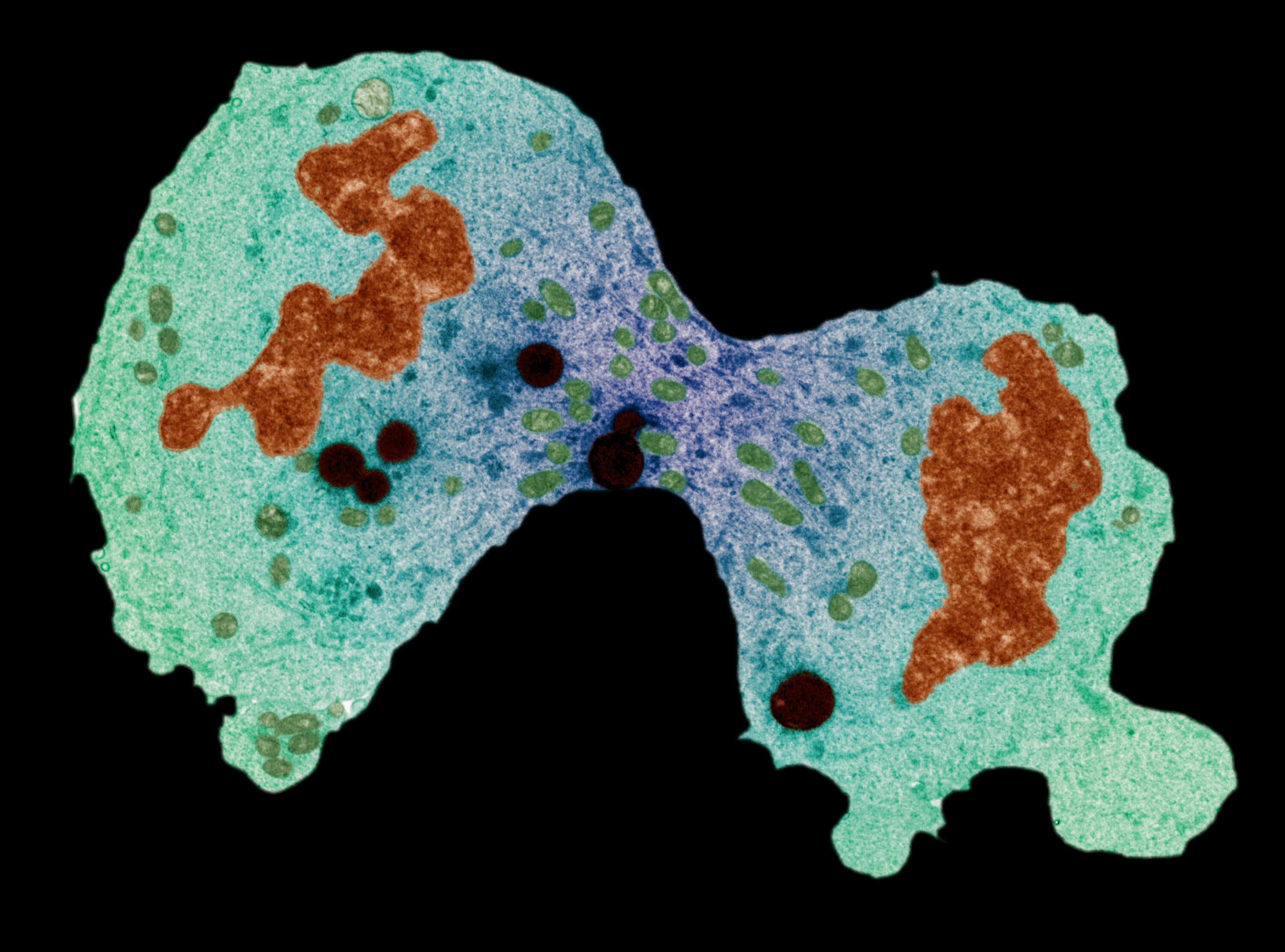 Microscopic cancer cells dividing.