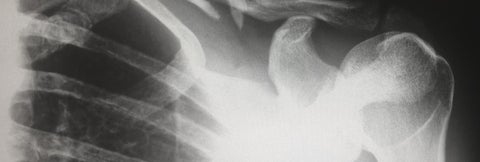 Xray of shoulder joint showing osteoarthritis.