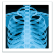 Xray of chest