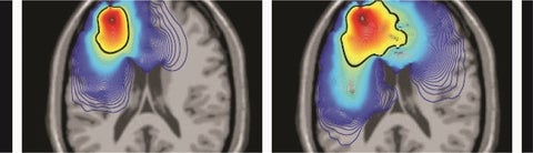 Simulation of high grade glioma growth (Powathil et al.)