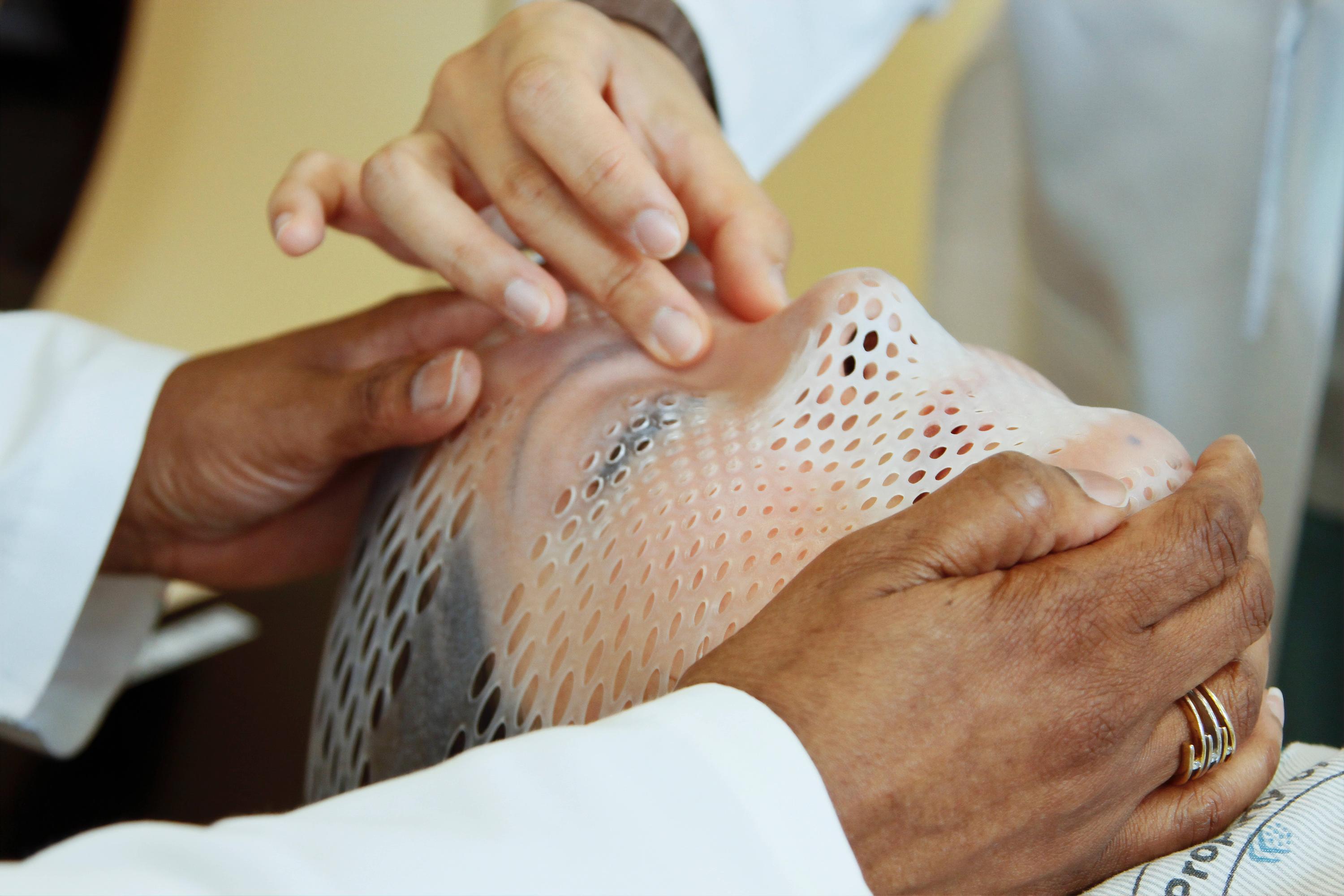 The hands of two radiation therapists are shown fitting a short face mask to a patient model to steady the head during radiation therapy.