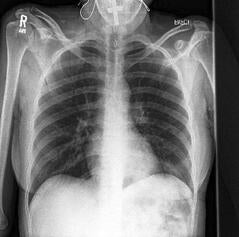 X-rays normal lung