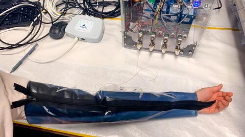 Compression sleeve with portable device to relieve Lymphedema pain