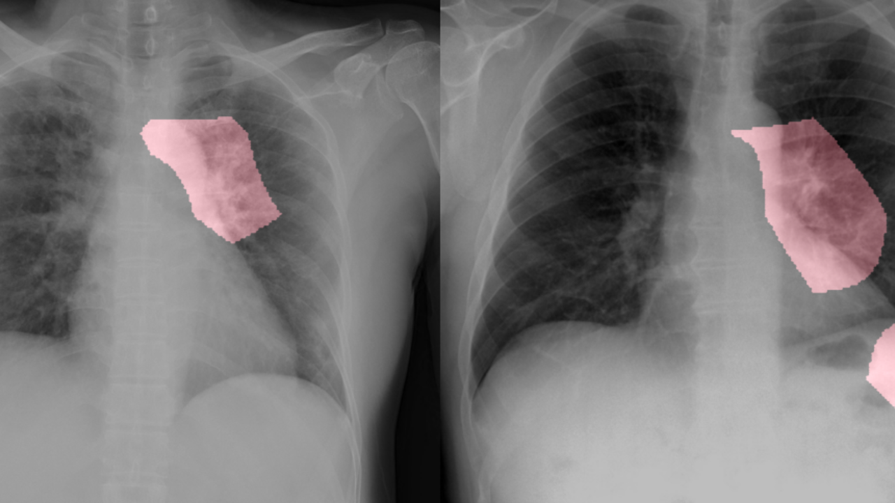 COVID-19 chest x-rays