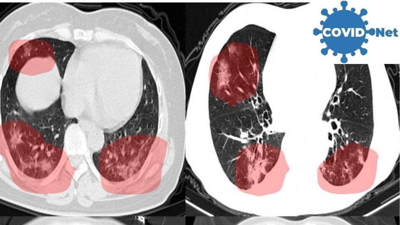 CT scans of lungs, with areas of concern highlighted by new AI software developed to screen for COVID-19.