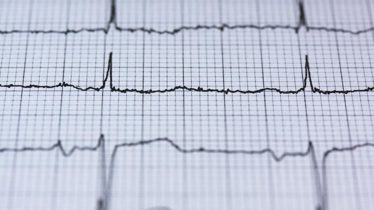 Electrocardiogram