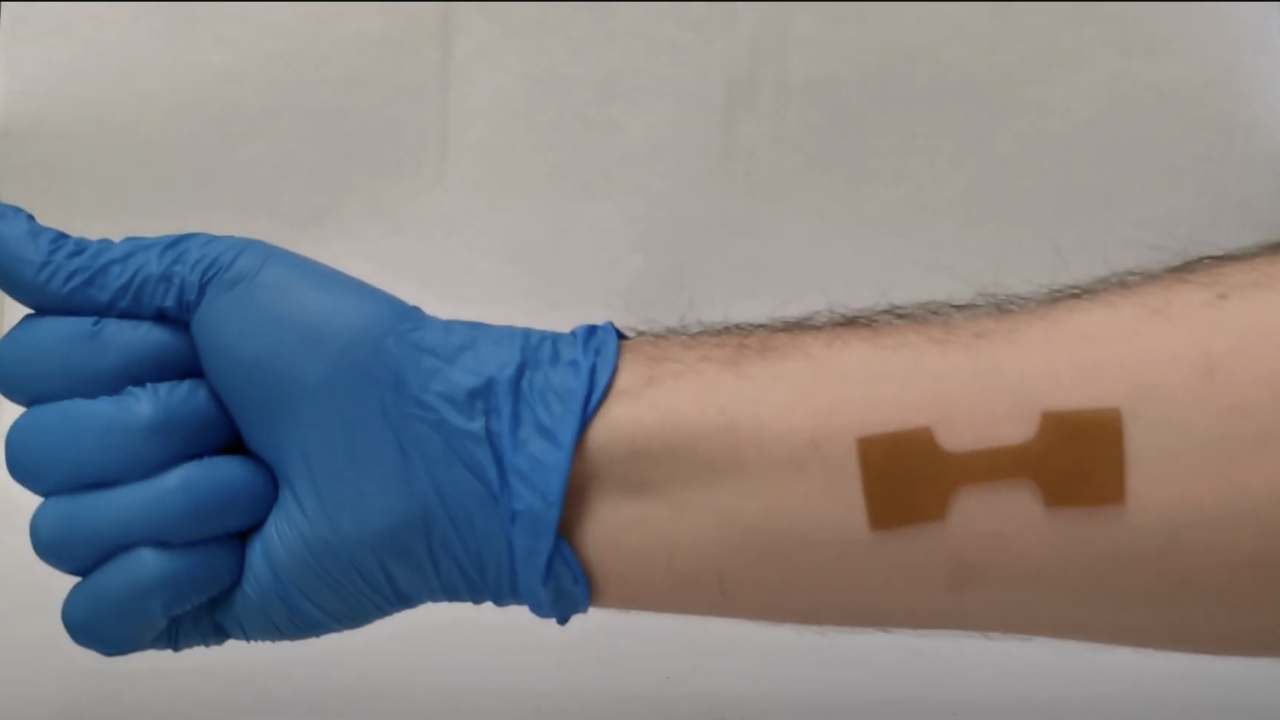 Wound dressing adhering to a person's arm when applied at body temperature.