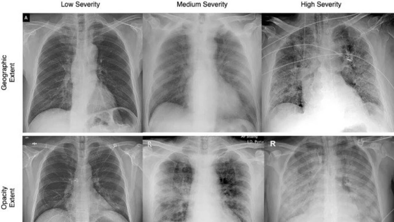 Chest x-rays of COVID-19 patients showing the extend and opacity of infections.