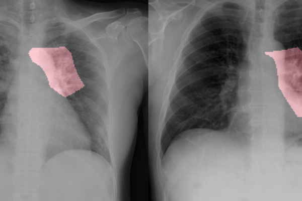 COVID-19 chest x-rays