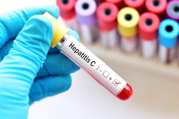 Blood sample positive with hepatitis C virus