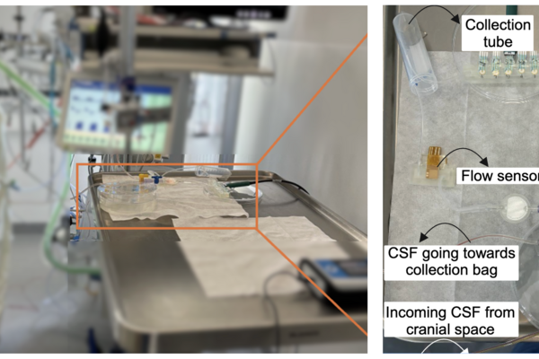 NeuroSense, a new bedside monitoring system designed to detect infections in brain-injured patients, being tested in an ICU.