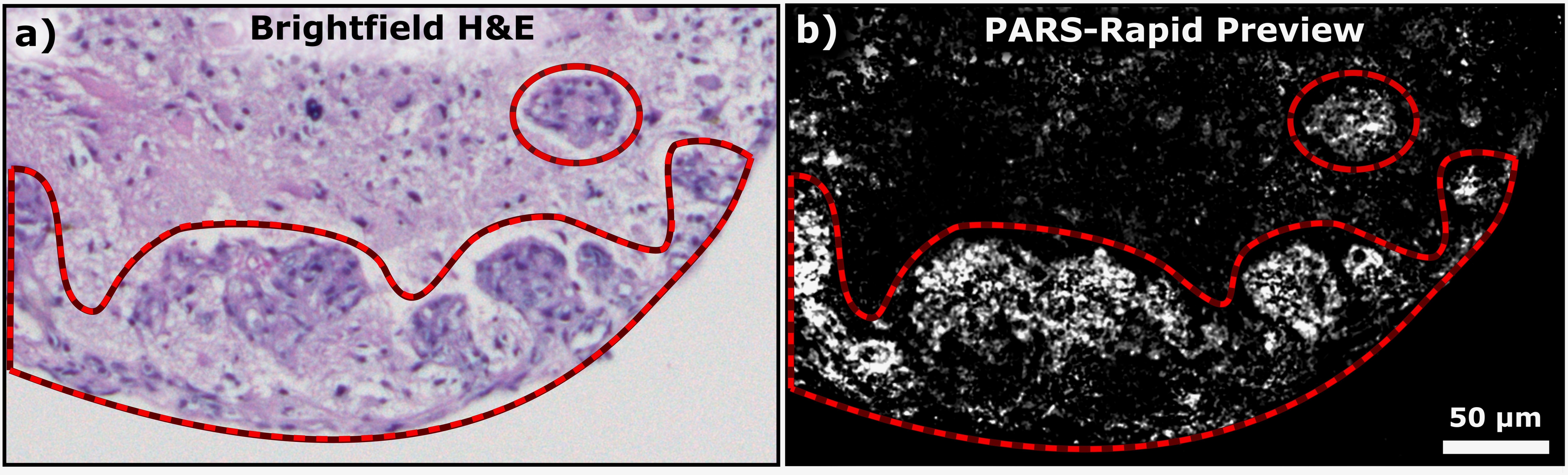 cancer in brain tissue