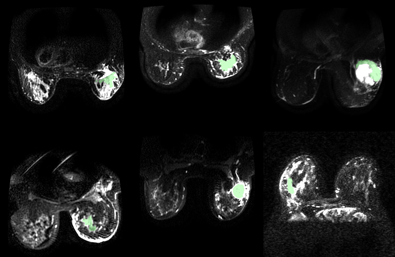 Several MRI images developed by the Waterloo research team show how cancerous tissue can "glow" in light green imaging