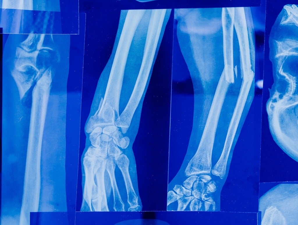 Bone xrays.