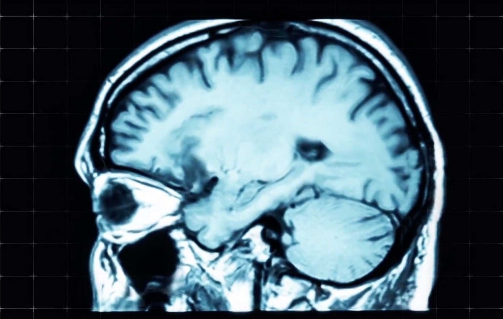 Xray of the brain