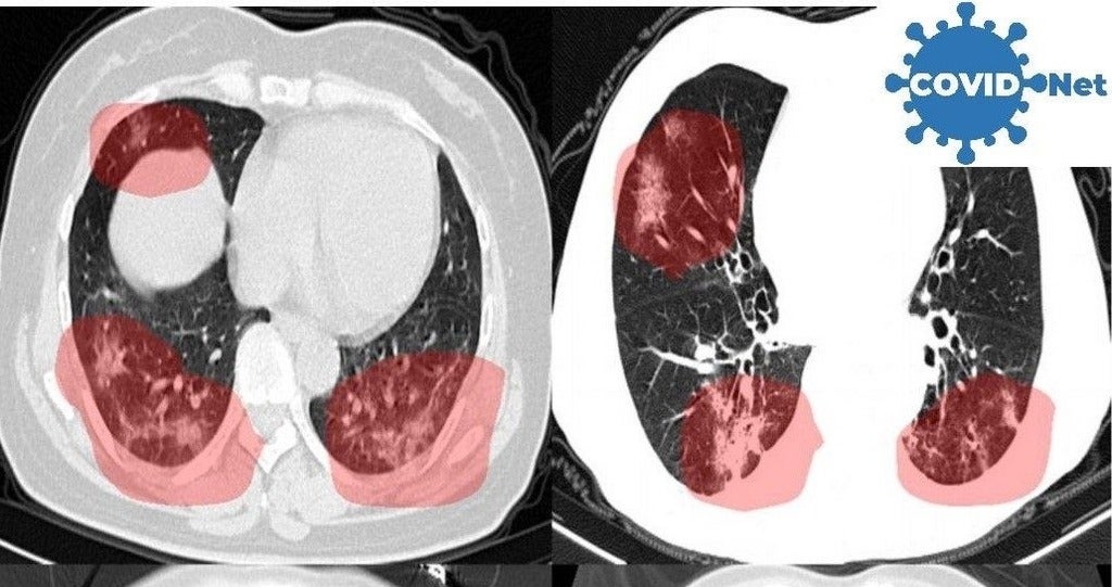 CT scans of lungs, with areas of concern highlighted by new AI software developed to screen for COVID-19.