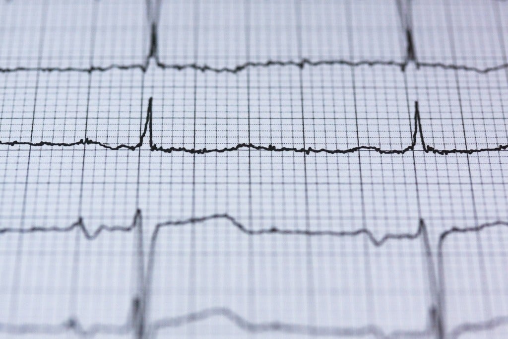 Electrocardiogram